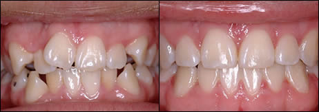 Case 4, crowding – before (left) and after (right), front view of the bite